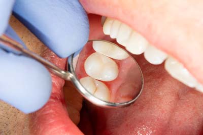 Tooth Colored Fillings FAQs