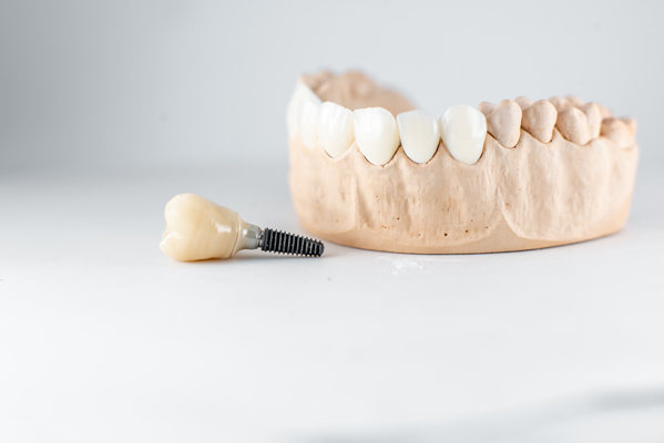 Dental Implant Placement Surgery FAQs